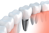 Denison dental implants