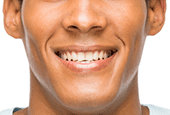 Denison tooth contouring