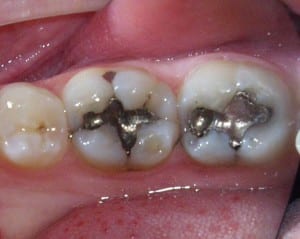 Denison mercury free fillings Newport News dentist dental fillings
