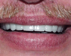 Denison After Treatment Cosmetic Dentistry NN VA
