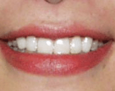 Denison After Cosmetic Dentistry